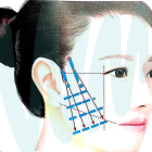 Làm đẹp da bằng phương pháp căng chỉ giá rẻ, bác sĩ cảnh báo điều gì?